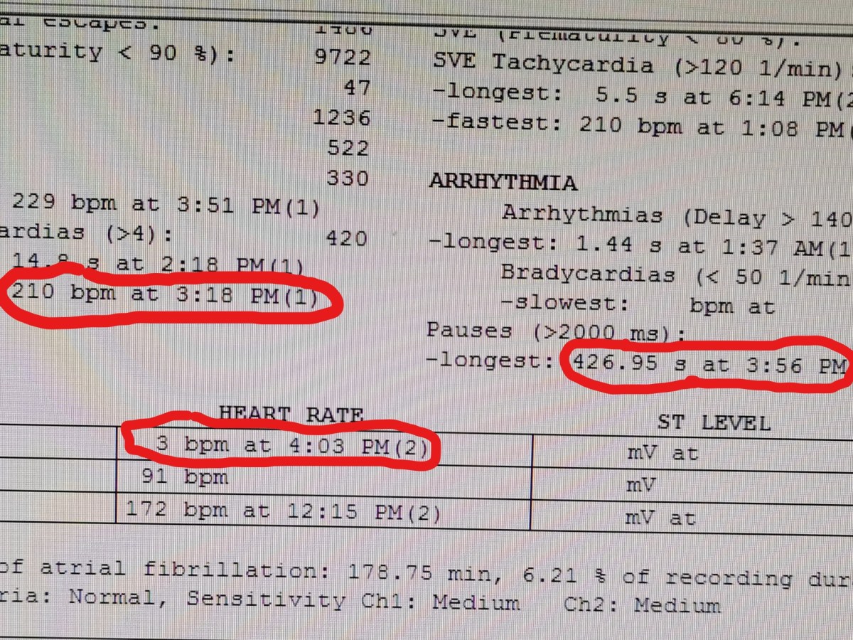 Holter-ul de ECG – ce este important sa stiu ca&nbsp;pacient