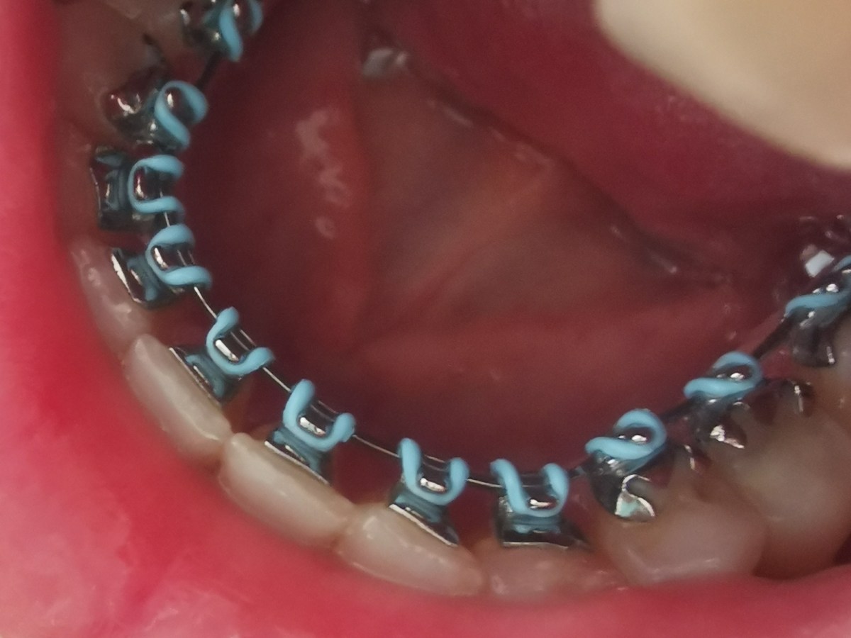 Anticoagulantele orale și intervențiile&nbsp;stomatologice