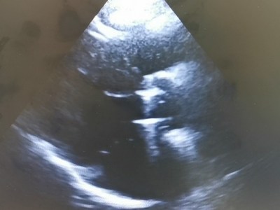 Mecanoproteza = dozare&nbsp;INR