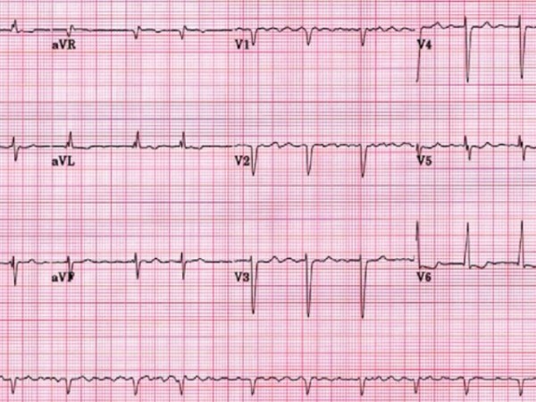 Fibrilatia atriala – o&nbsp;convertim?