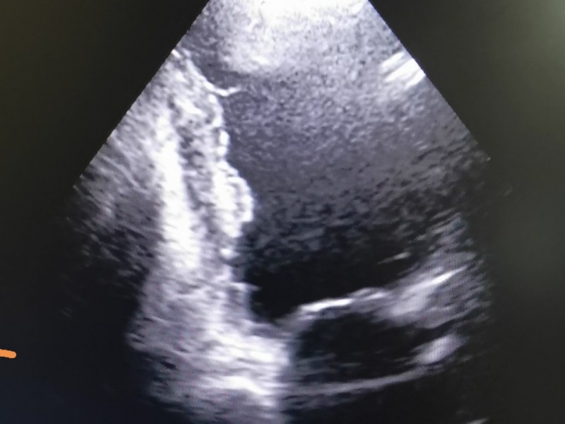 Trombul intracardiac