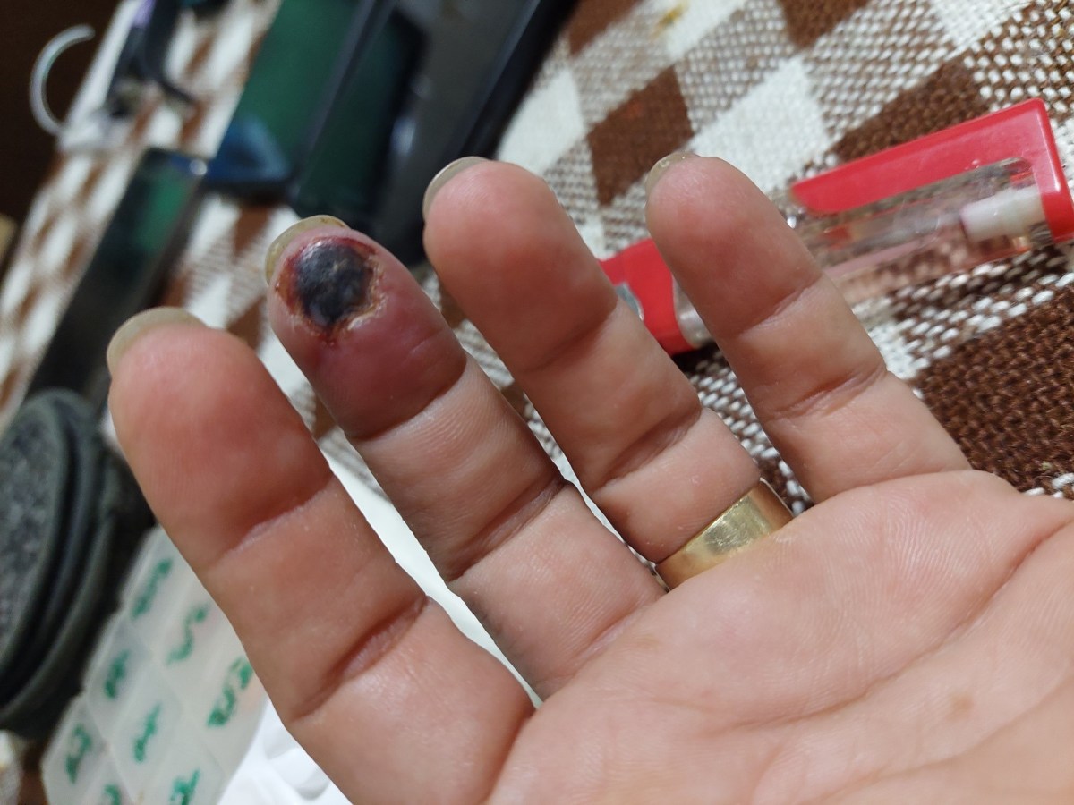 Fenomen Raynaud? – cand sa ne adresam&nbsp;medicului